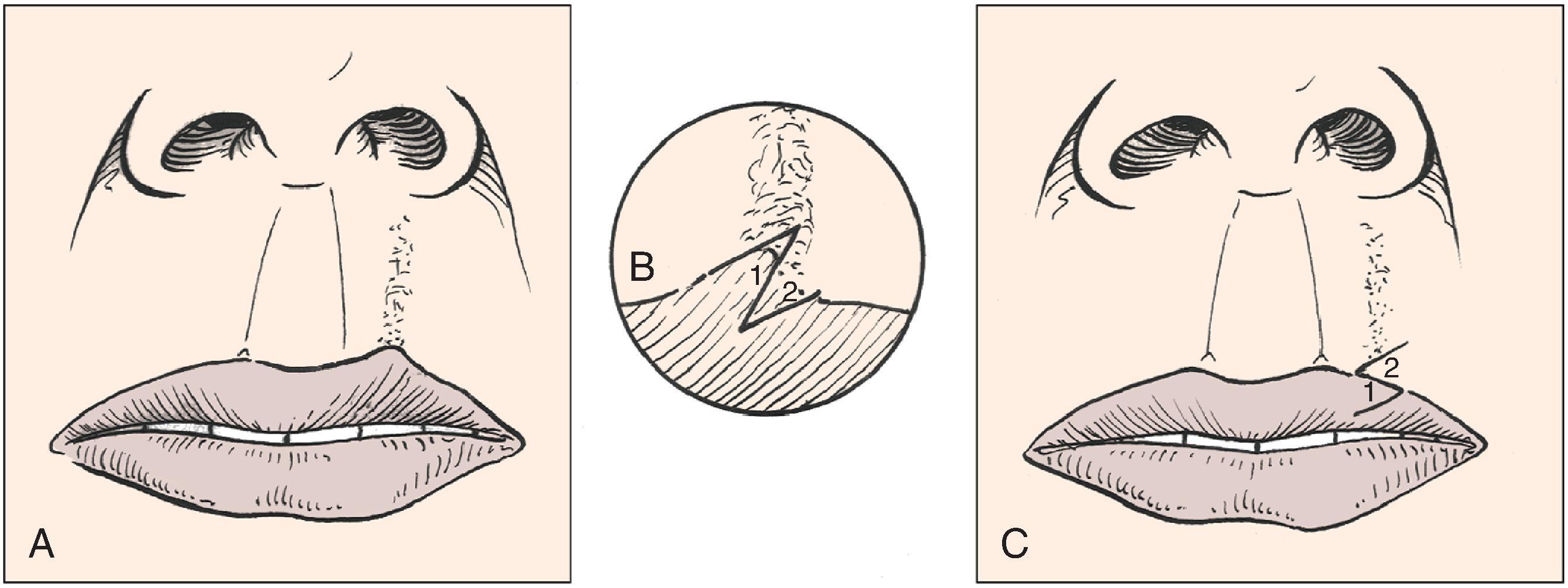 FIG. 14.13, Z-plasty used to correct irregularity of vermilion border.