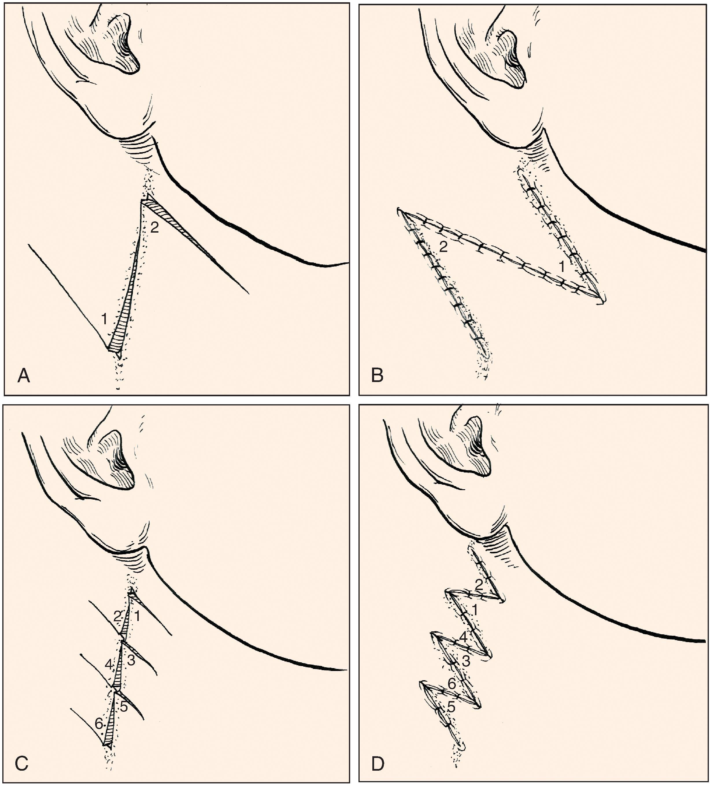 FIG. 14.14, Z-plasty used to correct webbed neck scar. A , B , Single Z-plasty. C , D , Multiple Z-plasties.