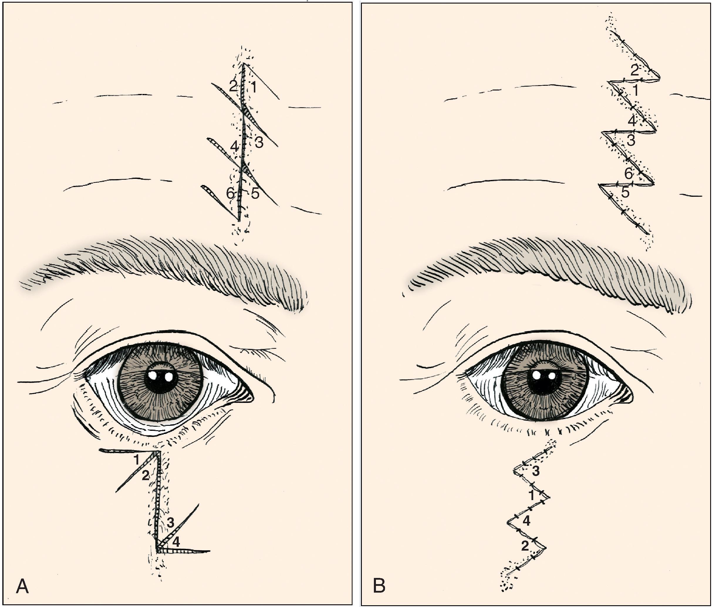 FIG. 14.15, Multiple Z-plasties used to improve camouflage of vertical forehead scar and to correct contracted lower eyelid and cheek scar.