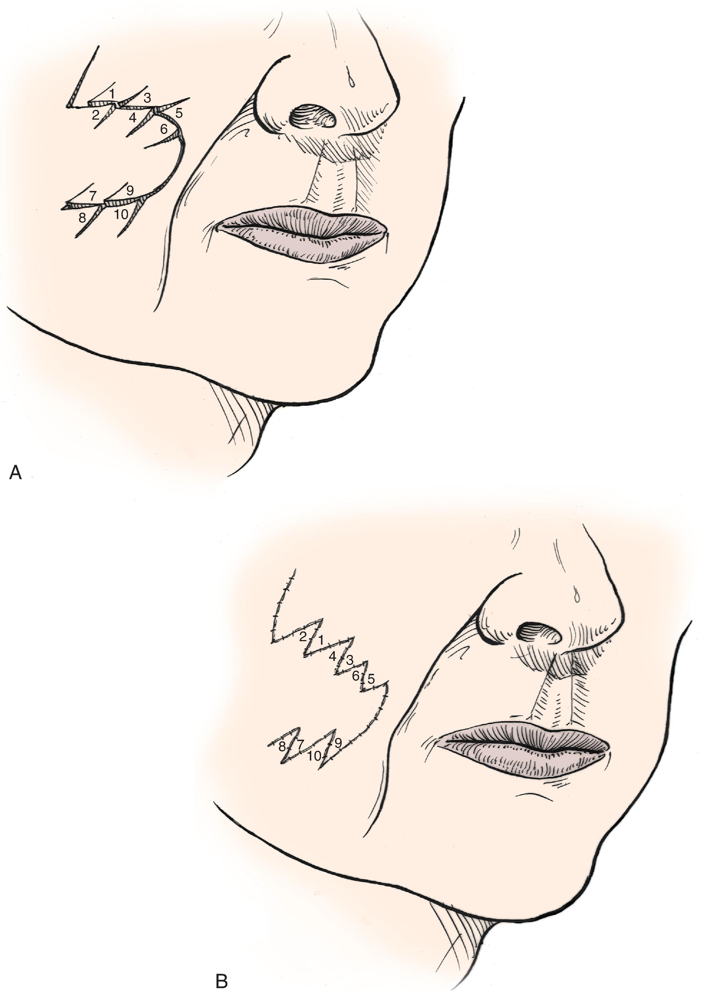 FIG. 14.16, Multiple Z-plasties used to correct trap-door deformity.