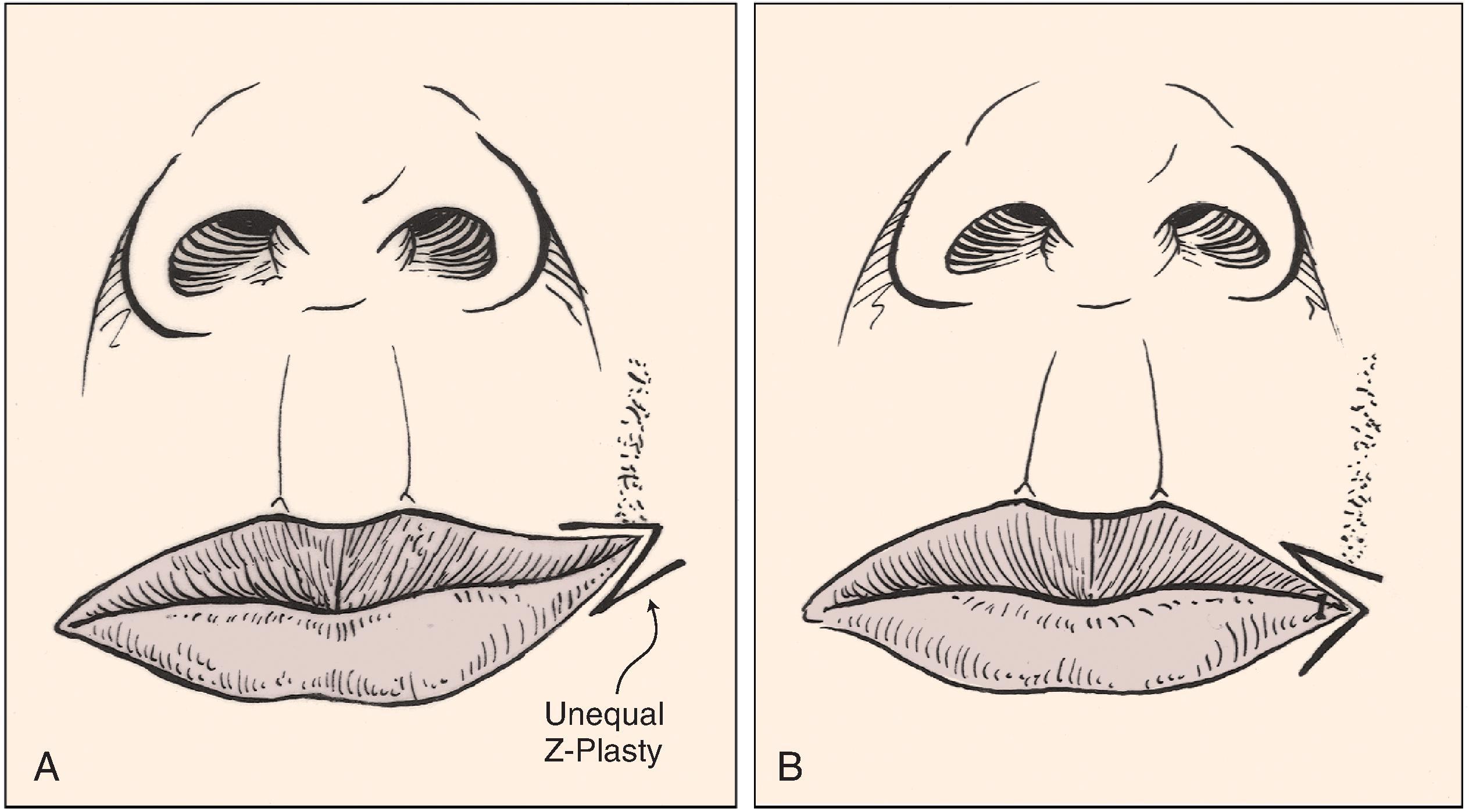 FIG. 14.17, Unequal Z-plasty used to reposition oral commissure.