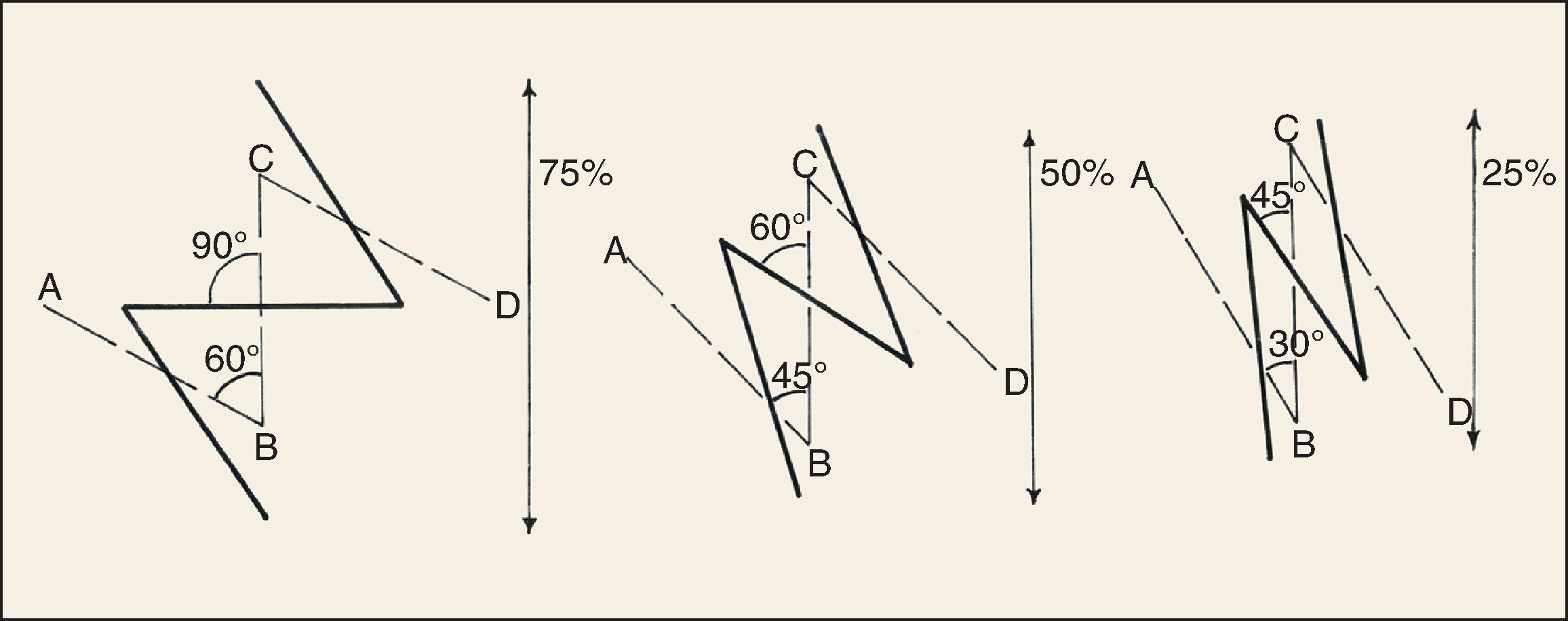 FIG. 14.2, Length gained in contracted scar and change in orientation of central limb of Z relative to Z-plasty angle. Greater Z-plasty angle causes greater change in scar orientation and lengthening of contracted scar.