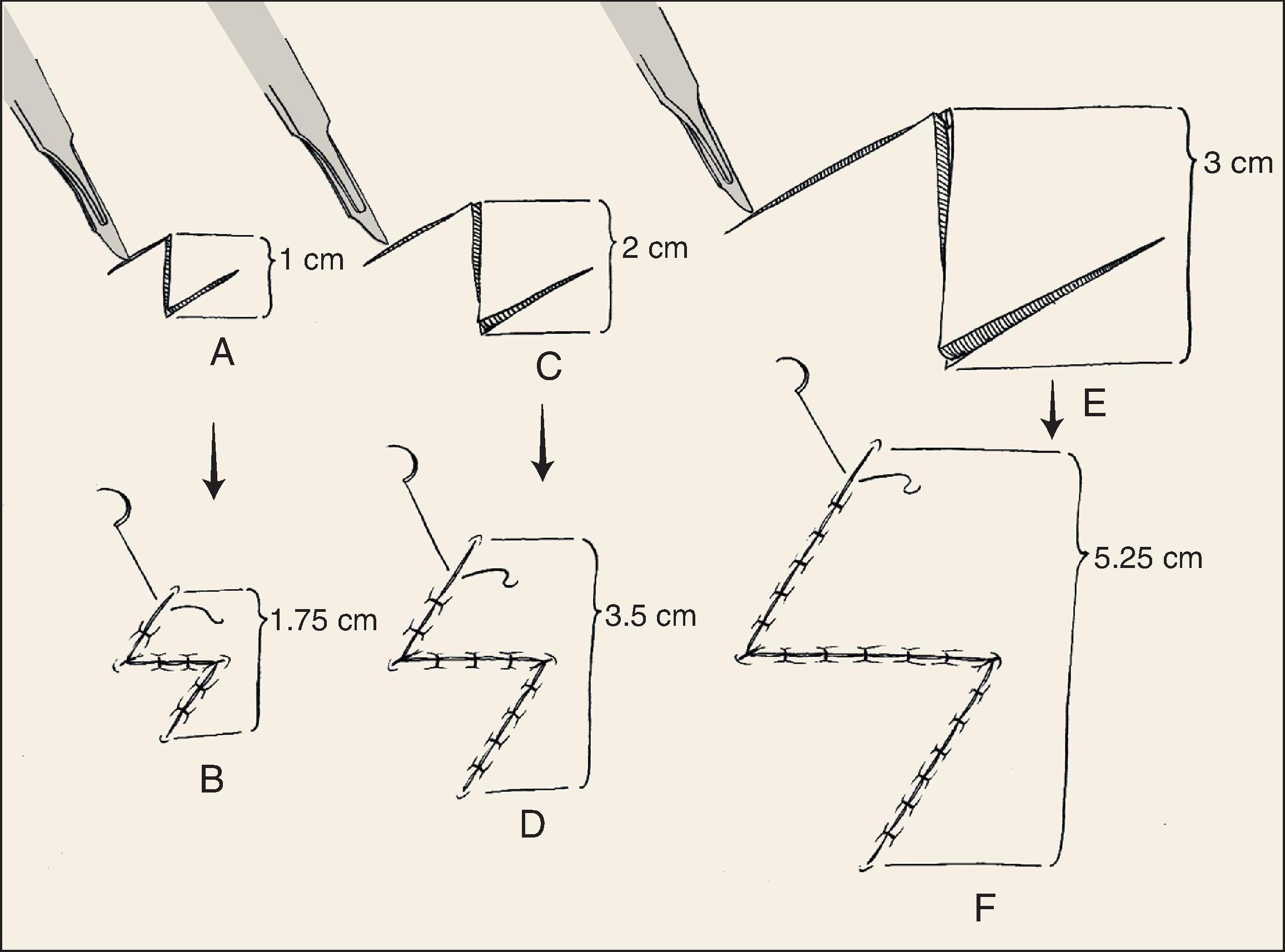 FIG. 14.3, Length gained in contracted scar relative to length of Z-plasty limbs. Longer limbs are associated with greater scar lengthening.