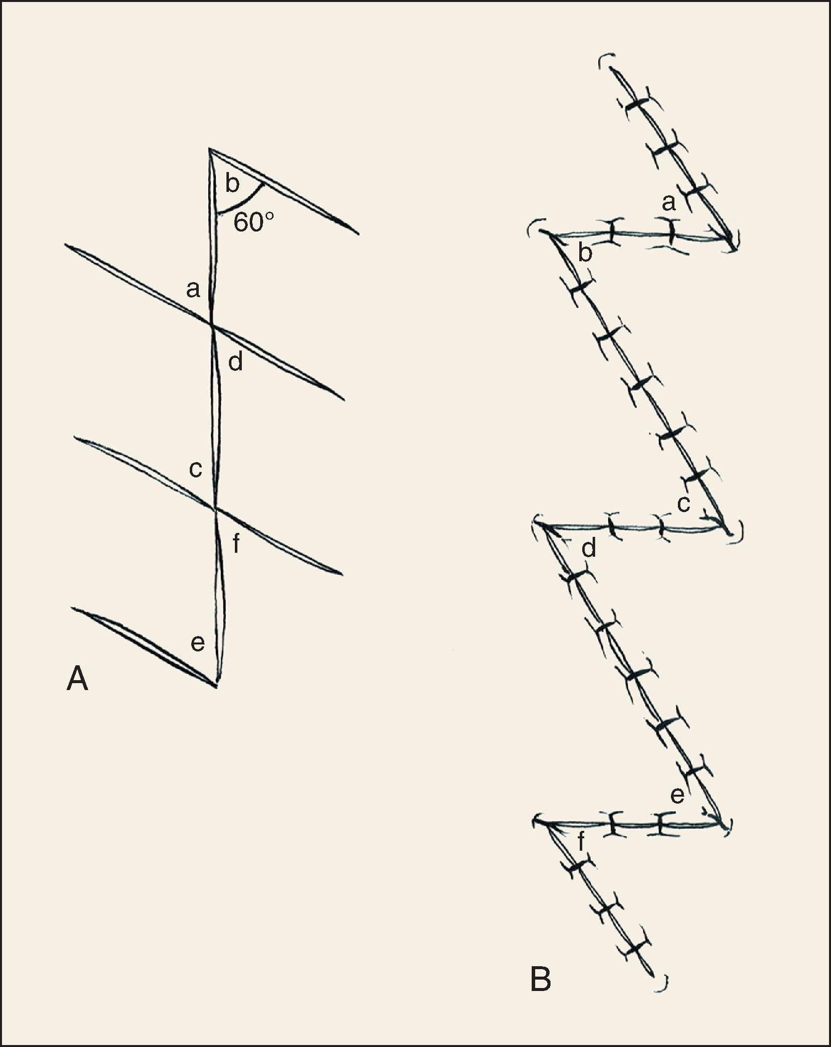 FIG. 14.4, Multiple Z-plasties. Limbs of Z are limited to less than 1 cm on face.