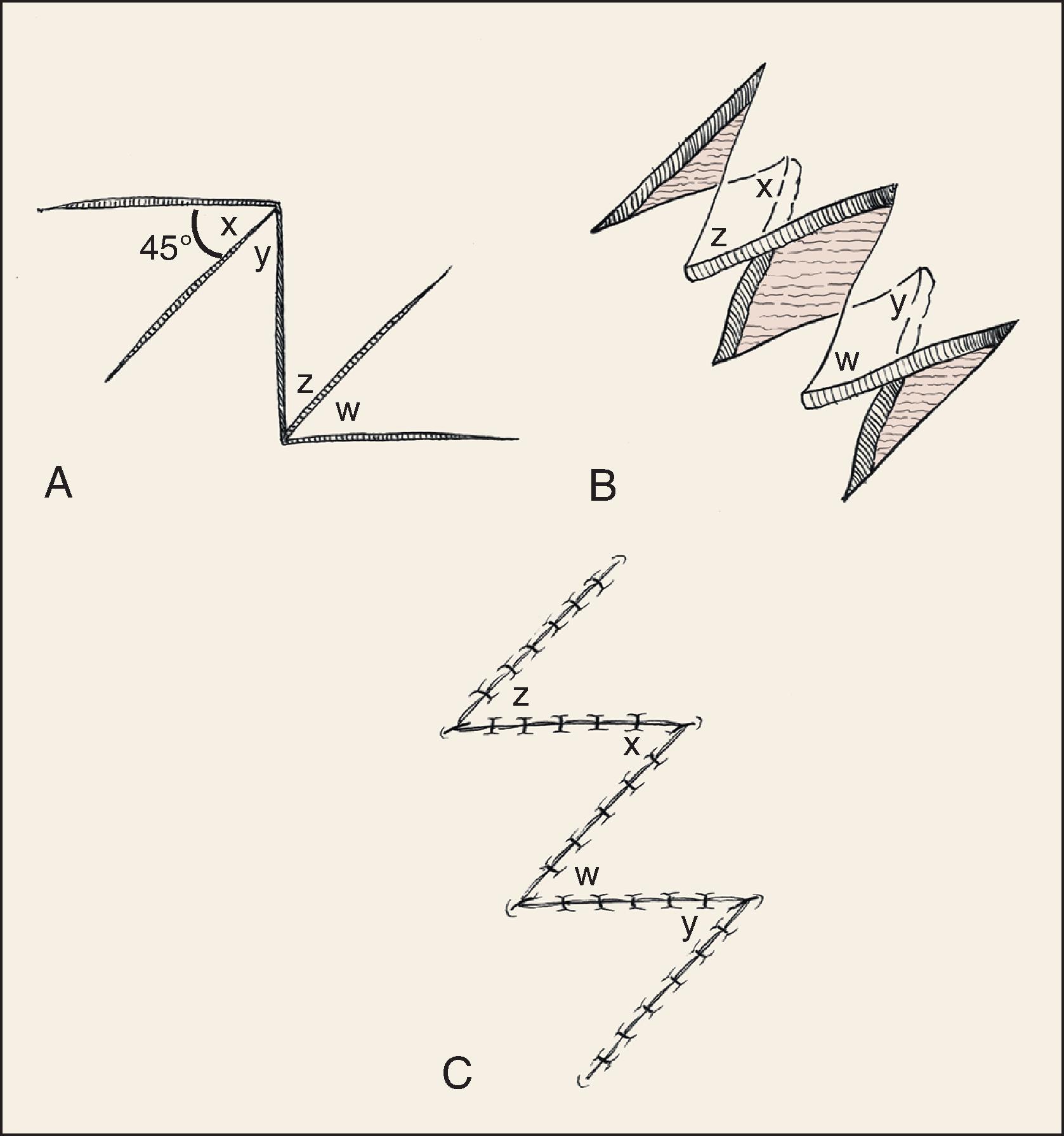 FIG. 14.5, The 45° compound four-flap Z-plasty.