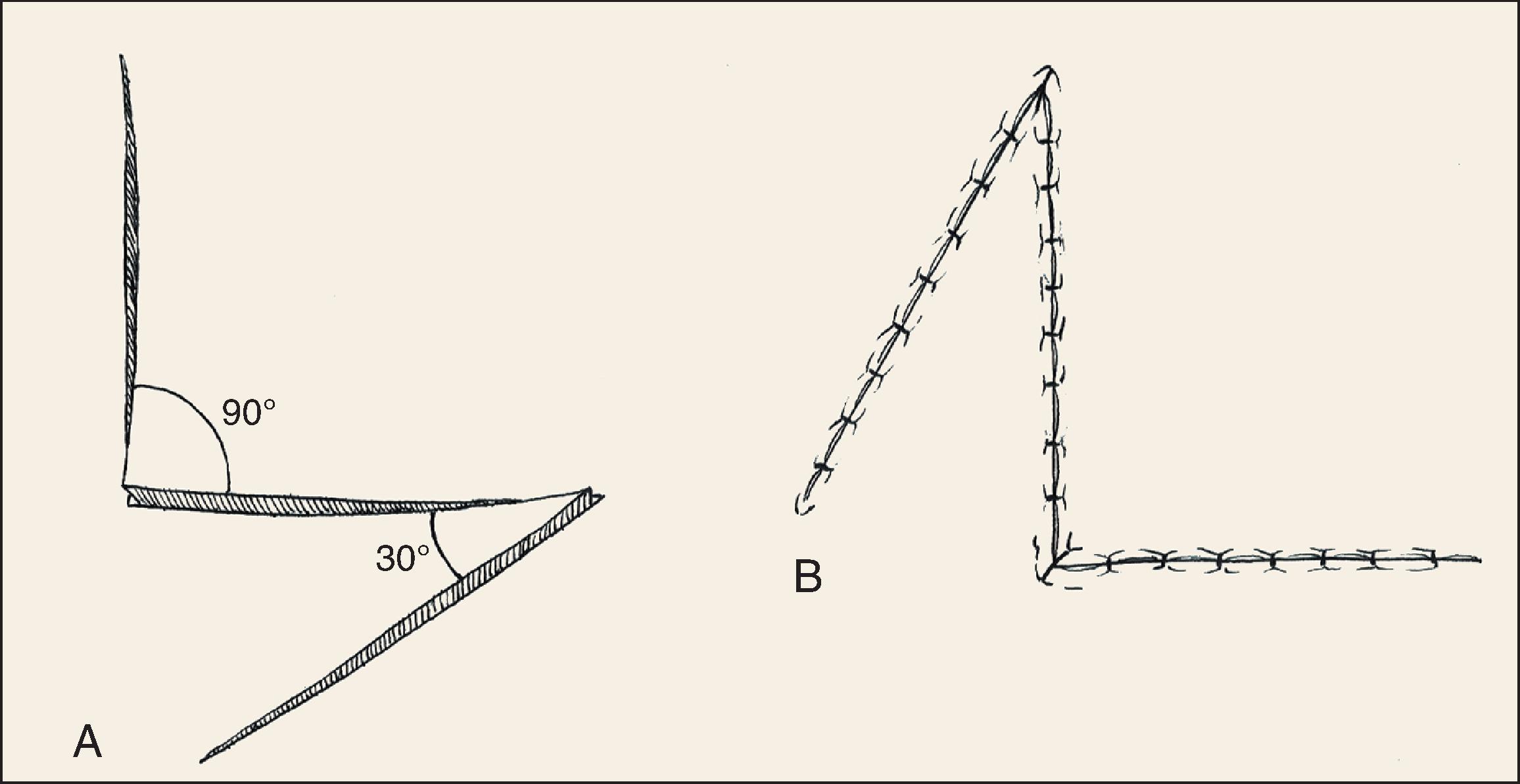 FIG. 14.7, Unequal-angled Z-plasty.