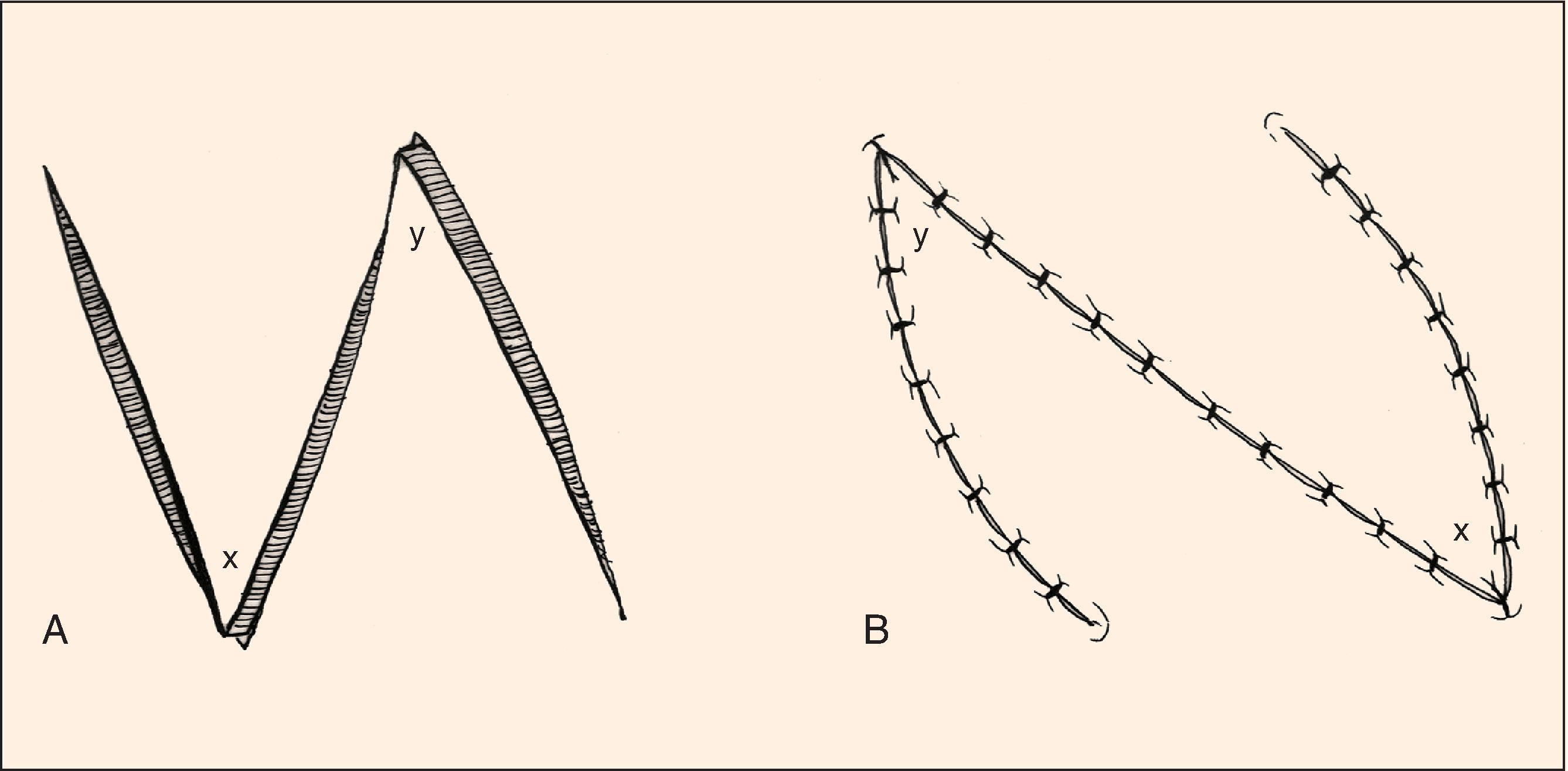 FIG. 14.8, Z-plasty with curved limbs to maximize vascular supply to tip of flaps.