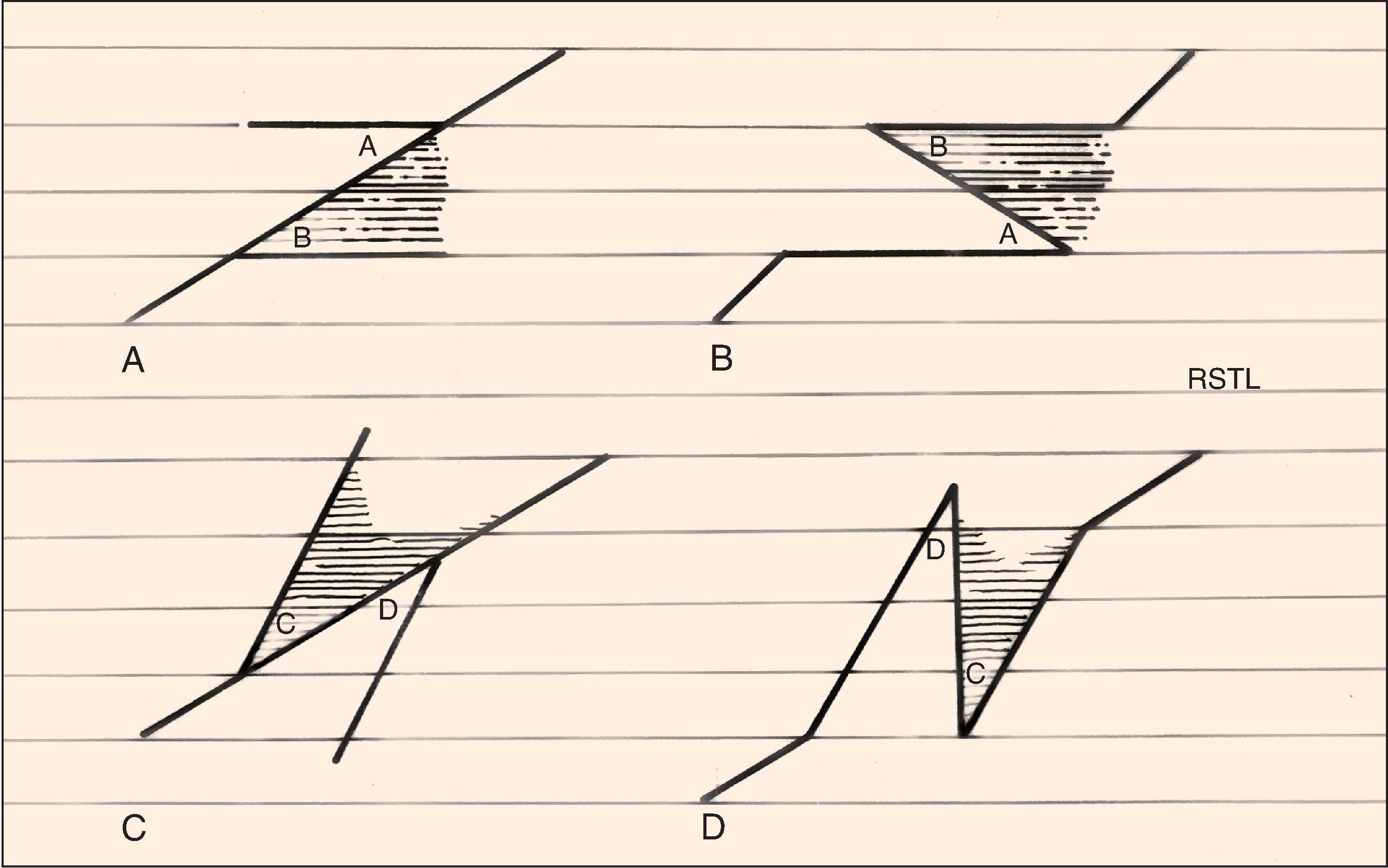 FIG. 14.10, Two alternatives for design of Z-plasty: A-B and C-D . A-B is the preferred alternative as it best aligns scars with relaxed skin tension lines.