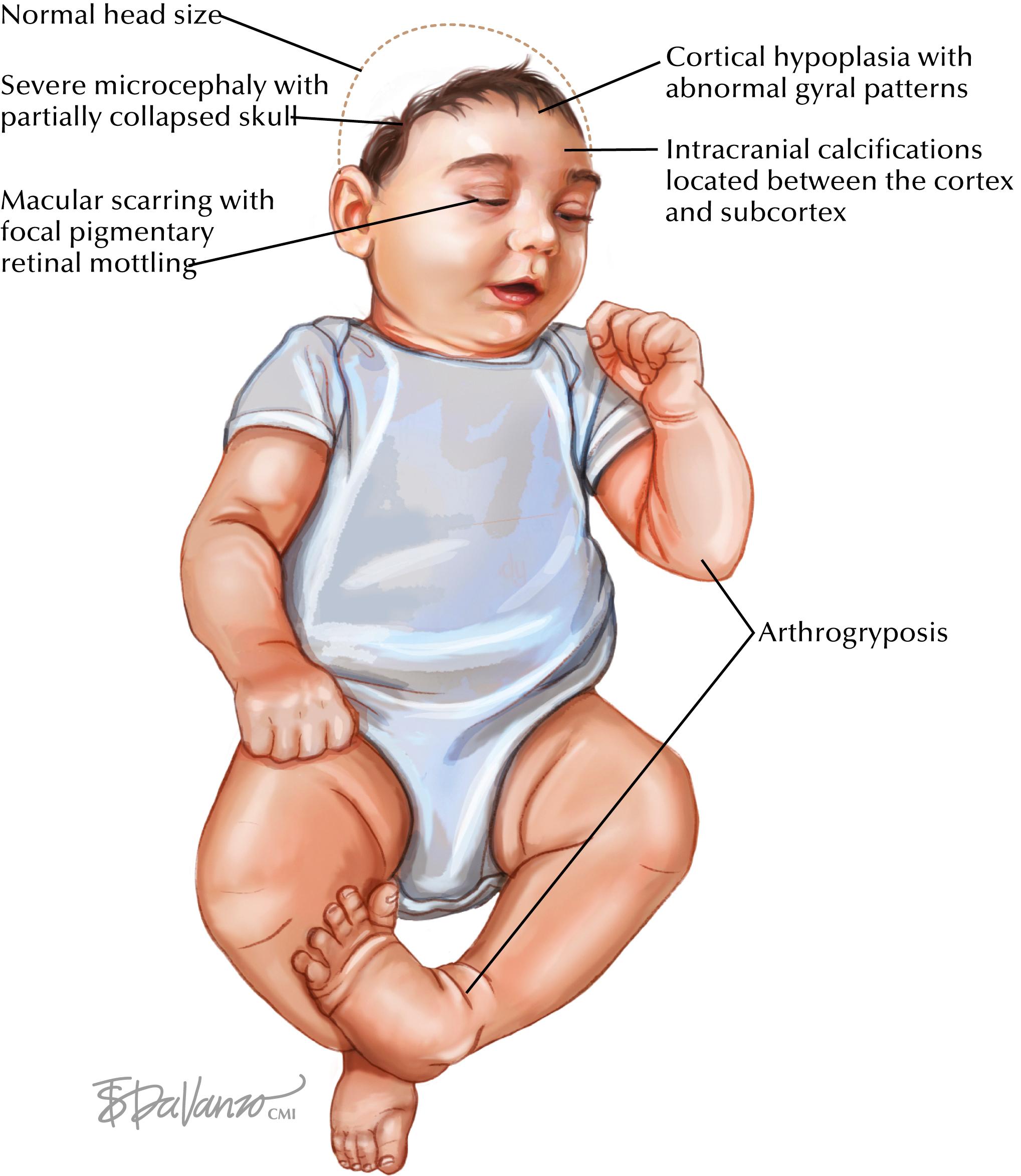 Fig. 92.2, Specific clinical findings in infants with congenital Zika virus infection.