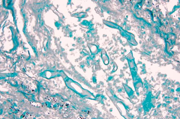 Figure 24-11, Zygomycete hyphae in same field as that shown in Figure 24-10 fail to stain with GMS. GMS variably stains zygomycetes. PAS and H&E stains are superior (GMS, 400 ×).