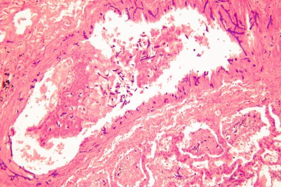 Figure 24-12, Angioinvasion with mycotic thrombus formation (H&E, 100 ×).