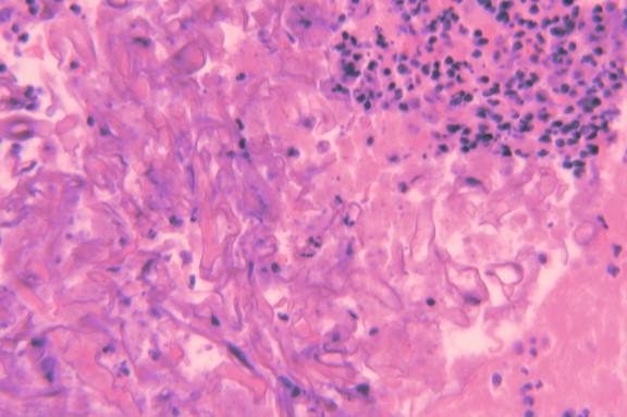 Figure 24-13, Masses of zygomycete hyphae within thrombus removed from branches of the pulmonary artery (H&E, 400 ×).