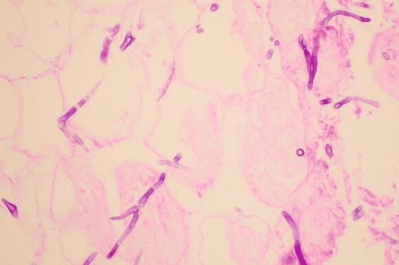 Figure 24-2, Rhizopus producing narrow hyphae with acute-angle branching simulating hyalohyphomycete such as Aspergillus . Zygomycete hyphal width can vary from 7 to 15 μm. Narrow zygomycete hyphae could be a cause of misdiagnosis. This field was within the same adipose tissue lobule as that shown in Figure 24-10 (PAS, 400 ×).