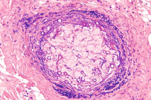 Figure 24-4, Periorbital nerve involvement in rhinocerebral zygomycosis. H&E staining demonstrates zygomycetes within the perineurium as well as invading nerve. Perineural involvement has been considered one possible mechanism for extension of infection into brain (H&E, 200 ×).