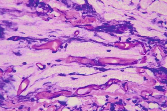 Figure 24-5, Neural involvement in rhinocerebral zygomycosis. PAS staining delineates zygomycete hyphae well (PAS, 400 ×).