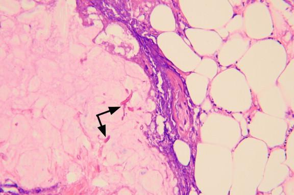 Figure 24-6, Zygomycete hyphae within fat necrosis of adipose tissue. Rhinocerebral zygomycosis produces extensive tissue damage in soft tissue. In all manifestations of zygomycosis, look for hyphae proliferating within fat lobules as seen here (H&E, 100 × ).