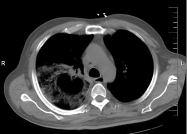 Figure 24-7, Invasive pulmonary zygomycosis producing a cavitary lesion in right lung. This man had received a kidney transplant 3 weeks earlier.