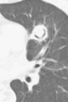 Figure 24-8, Air-crescent sign in a patient recovering from zygomycetes pulmonary infection. The air-crescent sign may appear during recovery from mycotic infection and results from retraction of the infarcted lesion producing an air-filled space. This sign is often associated with Aspergillus infection but can occur with any mold infection as well as other lung infections caused by mycobacteria, Nocardia, or bacteria.