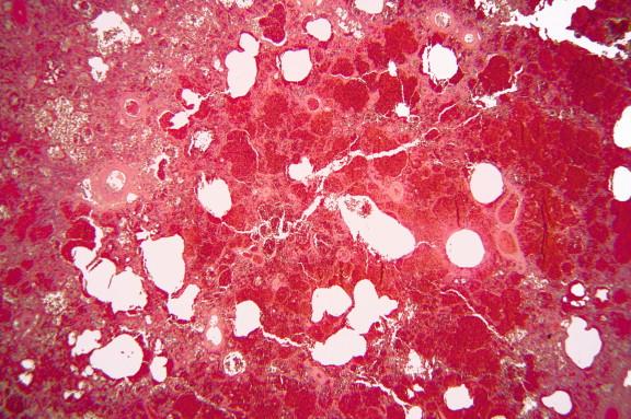 Figure 24-9, Pulmonary hemorrhage in right lung of kidney transplant patient. Resected lung demonstrated pulmonary hemorrhage, acute pneumonia, and infarction. Zygomycetes were found mainly in infarcted areas (H&E, 100 ×).