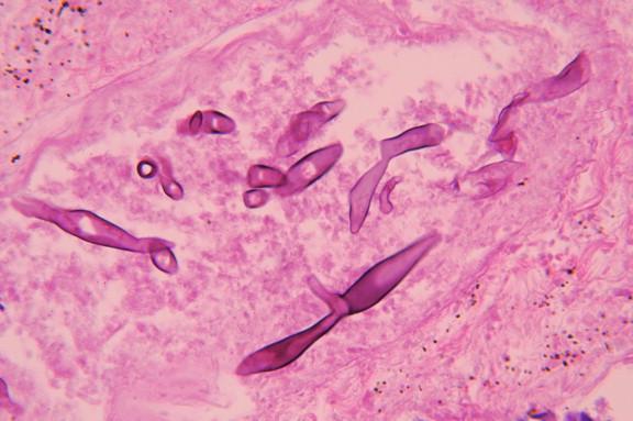 Figure 24-10, Irregular, twisted hyphae of zygomycetes within infracted area of lung. Hyphae predominate in areas lacking neutrophil infiltration (H&E, 400 ×).