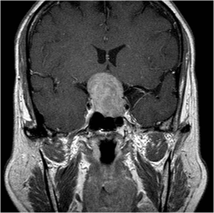 MRI Brain