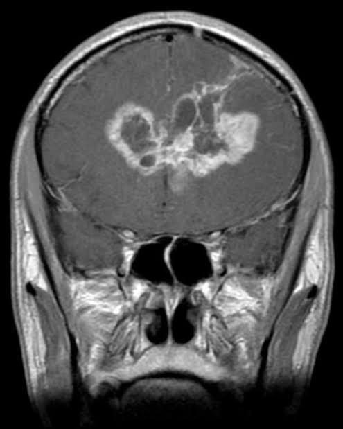 MRI Brain