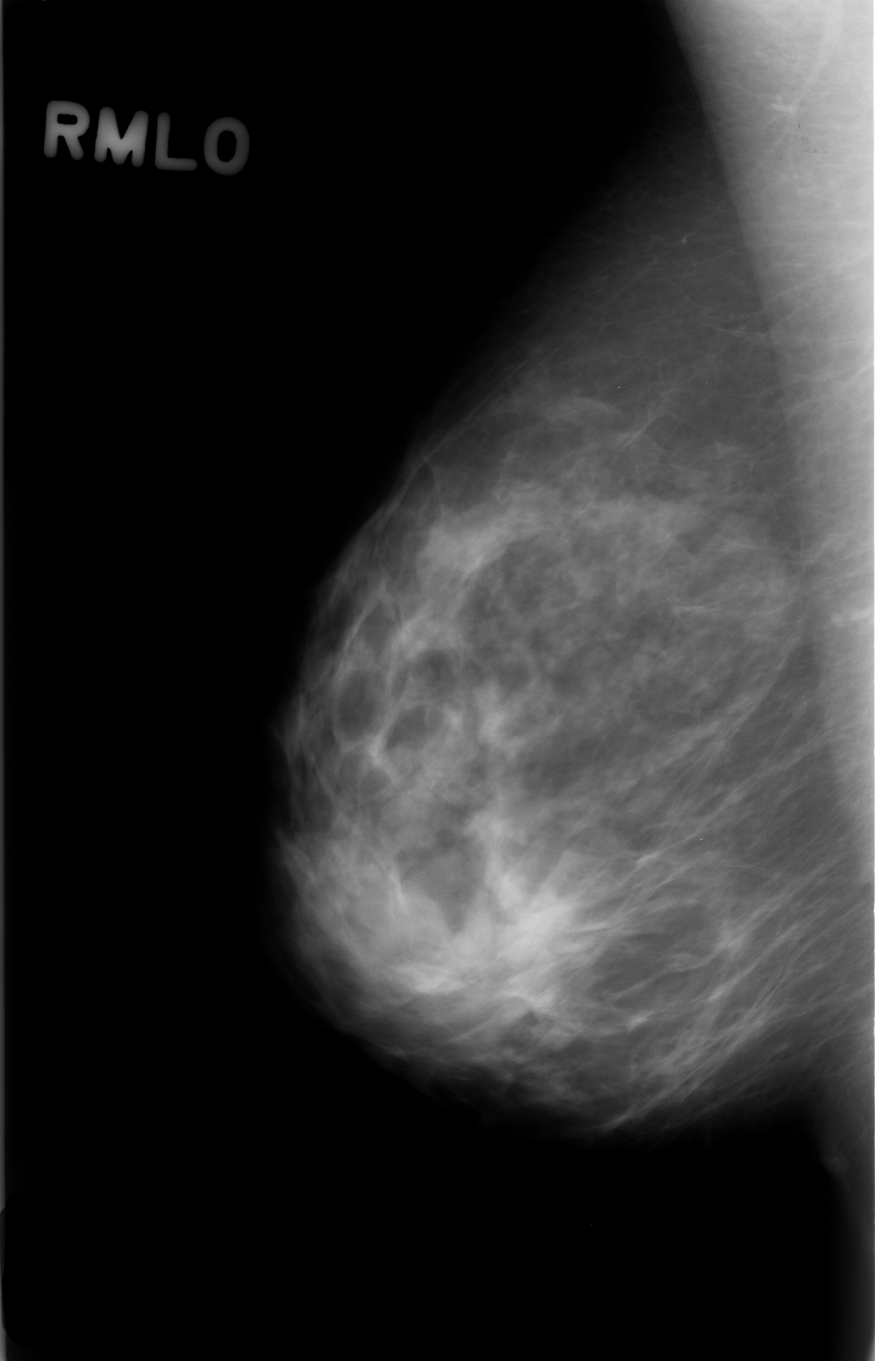 Mammography