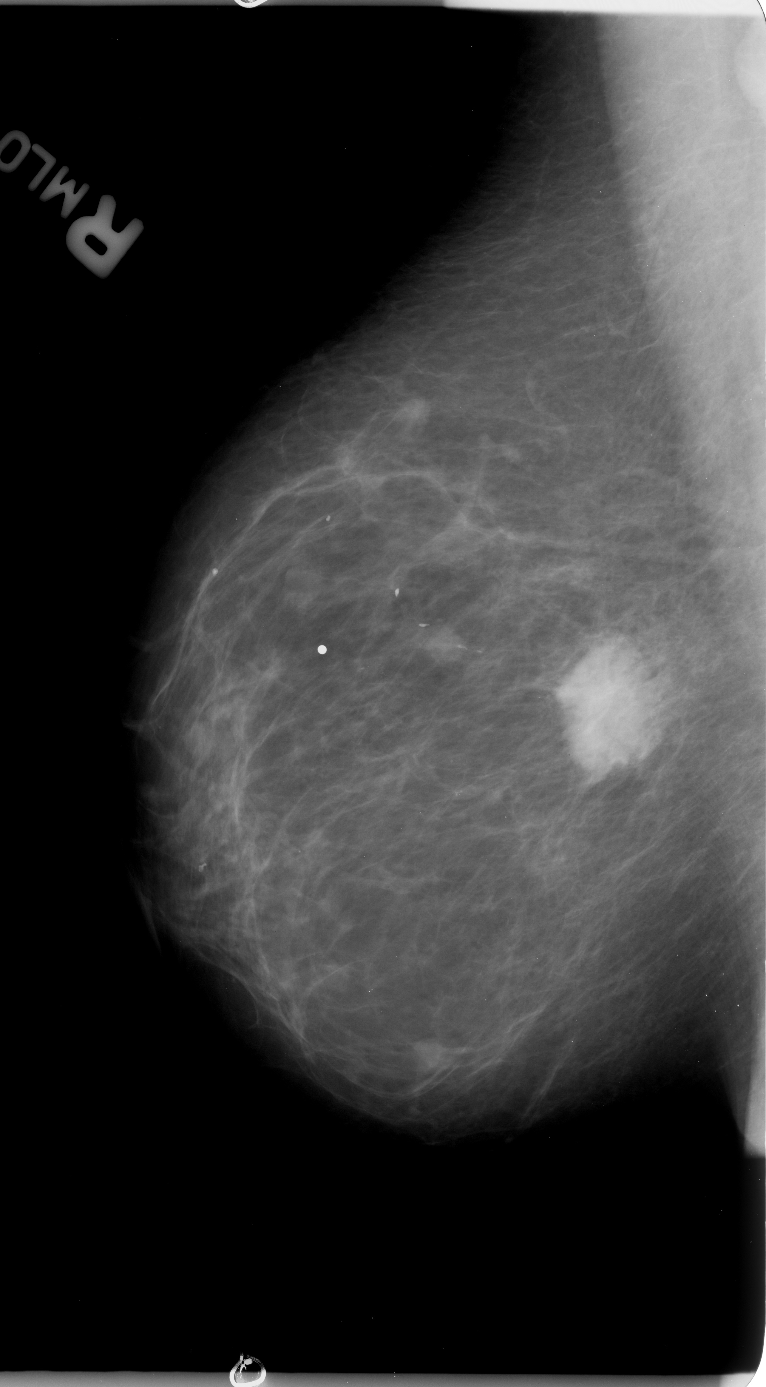 Mammography