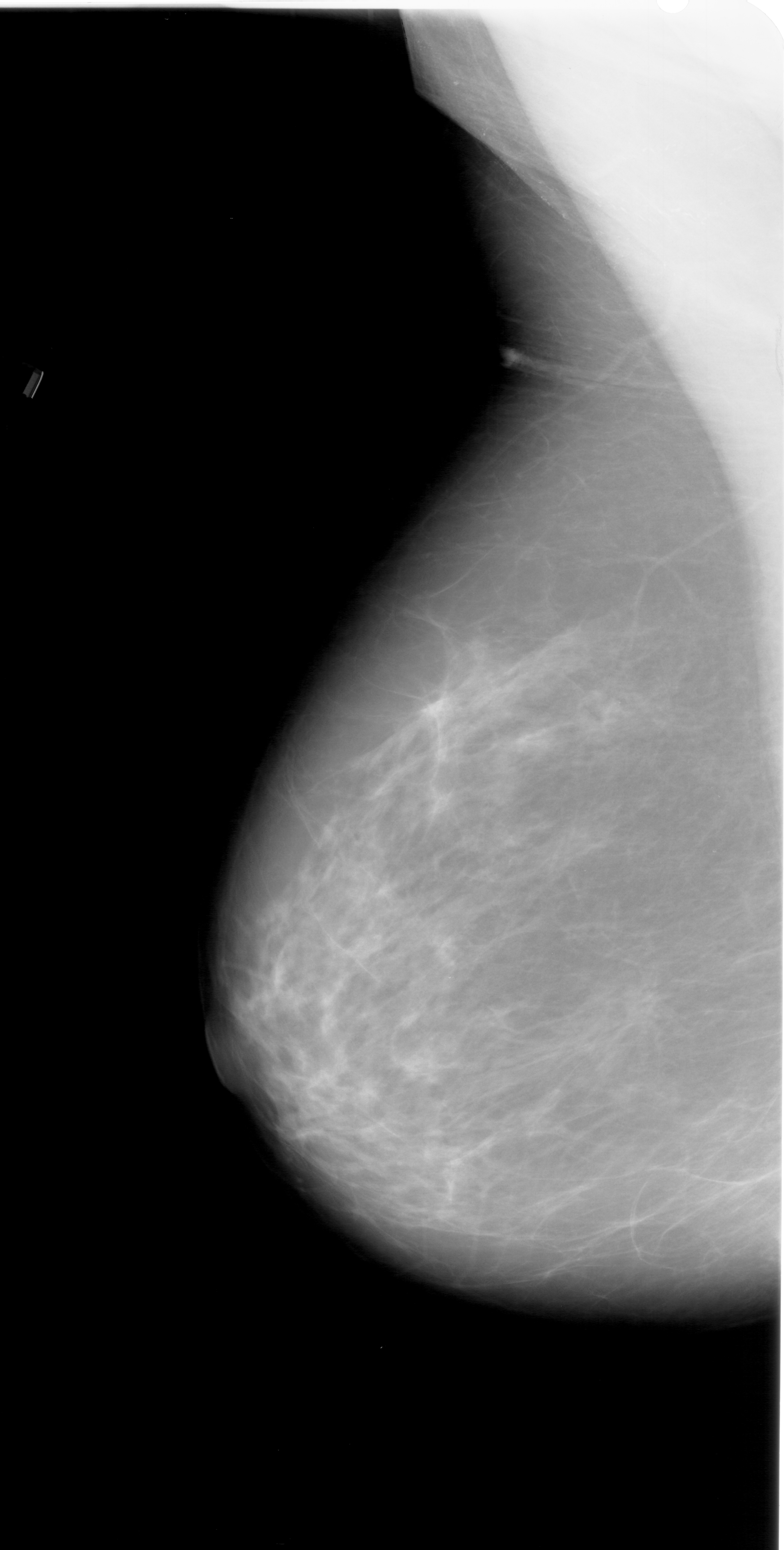 Mammography