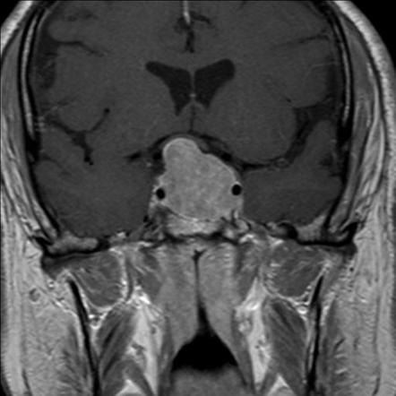 MRI Brain