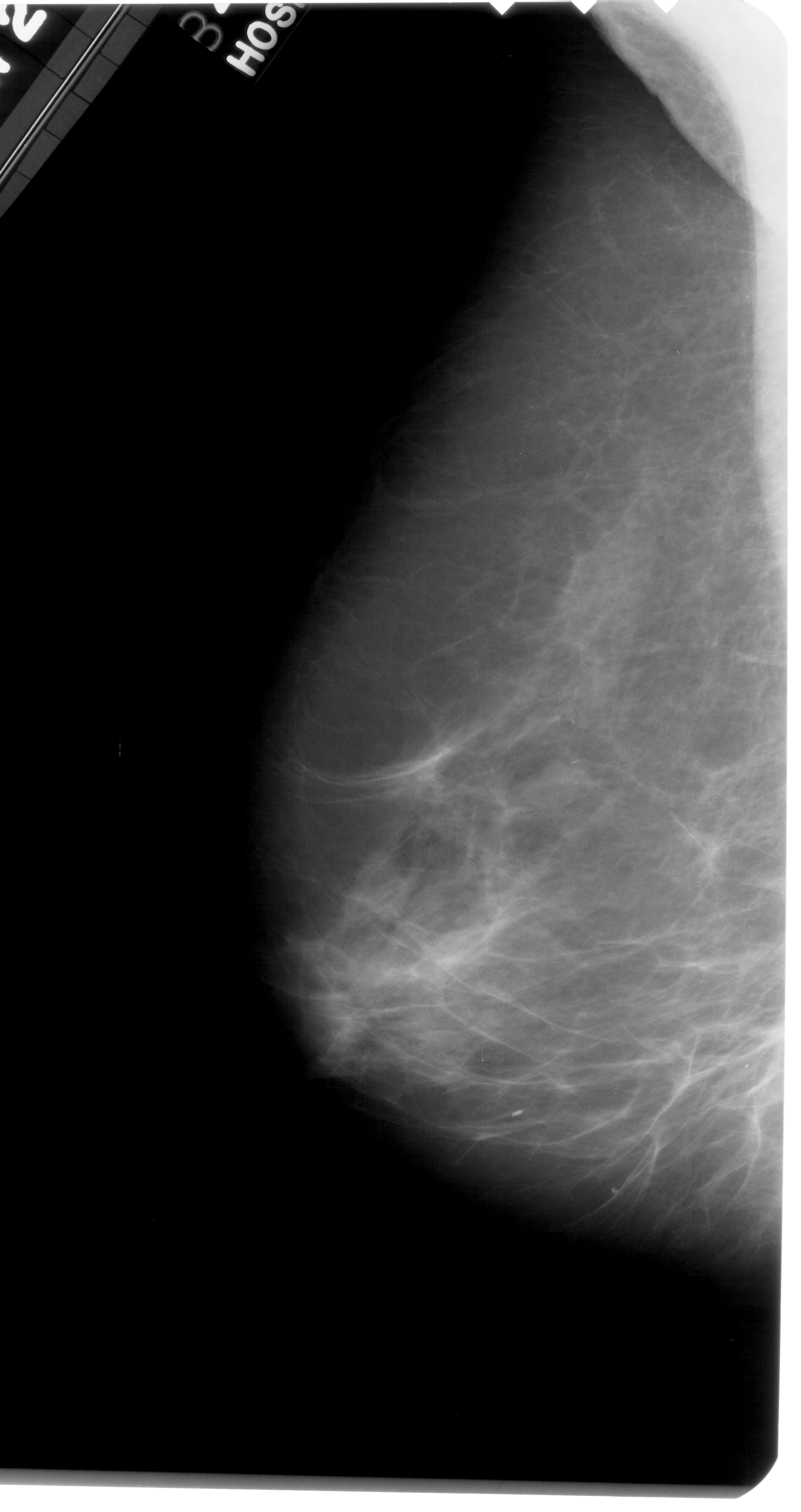 Mammography