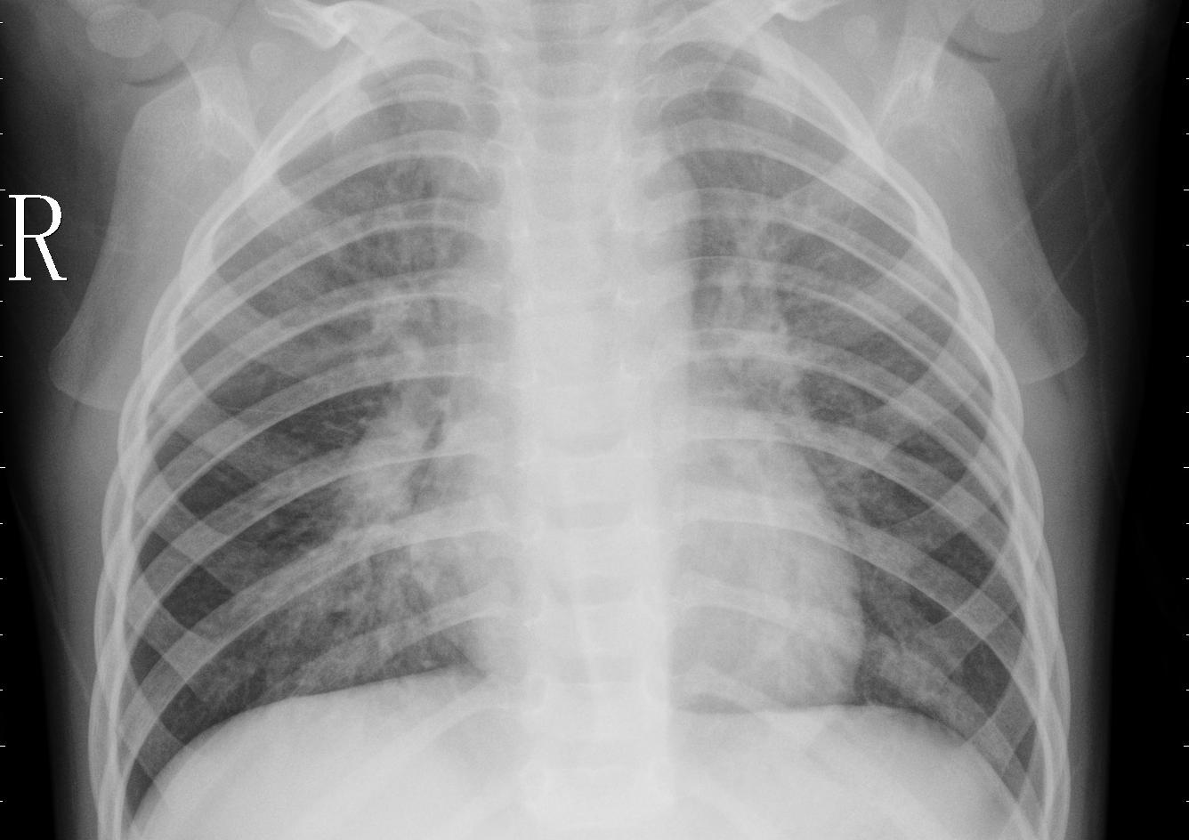 Chest Radiograph