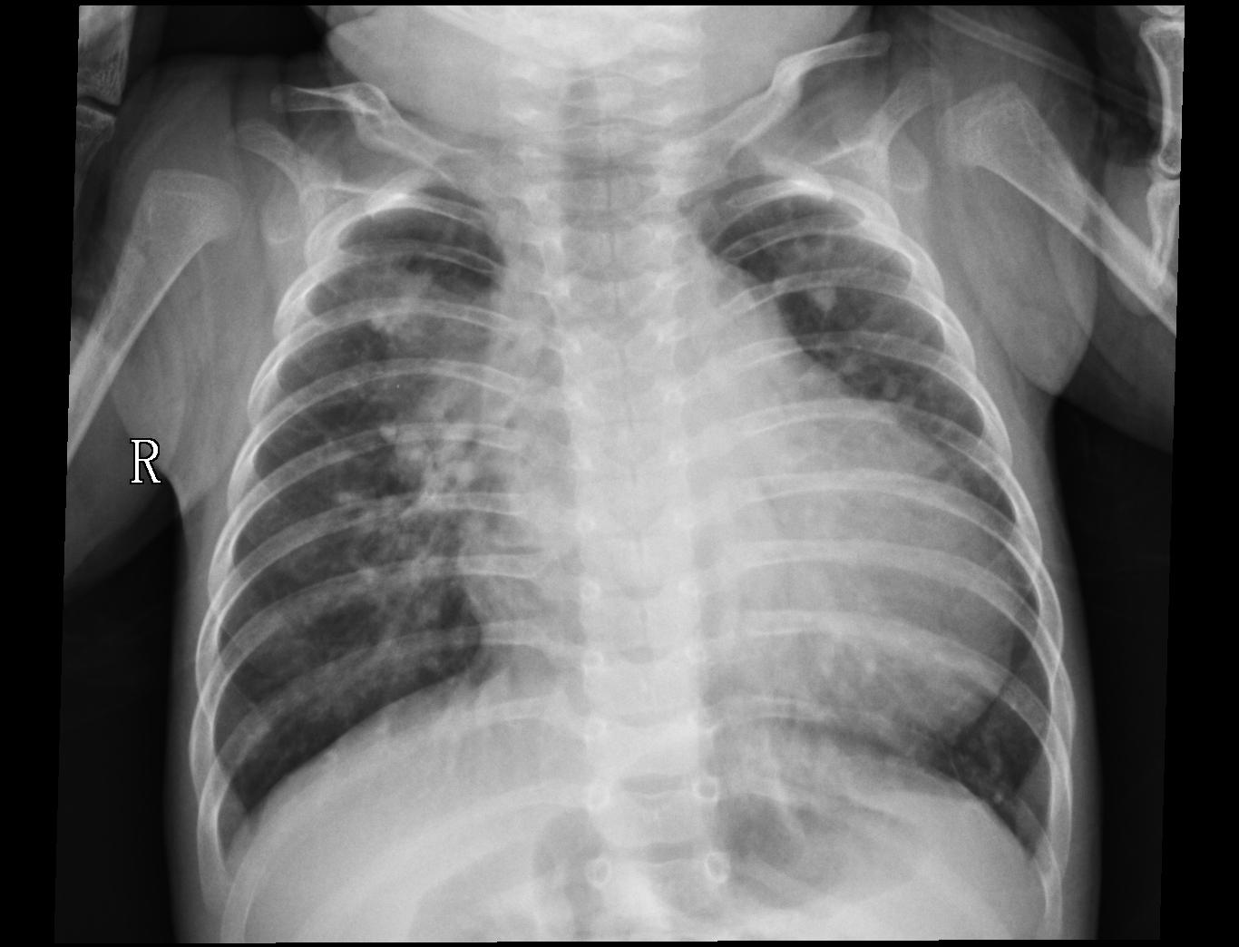 Chest Radiograph