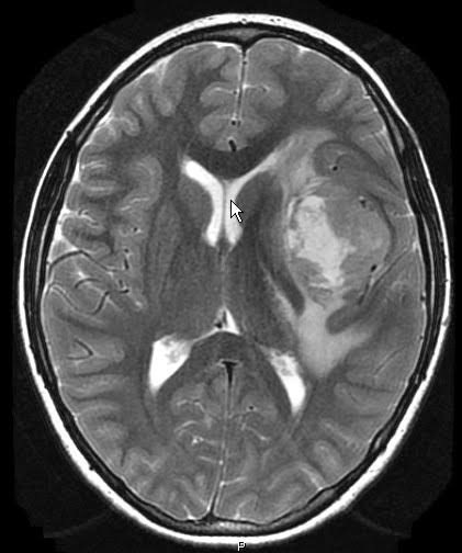 MRI Brain