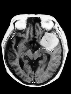 MRI Brain