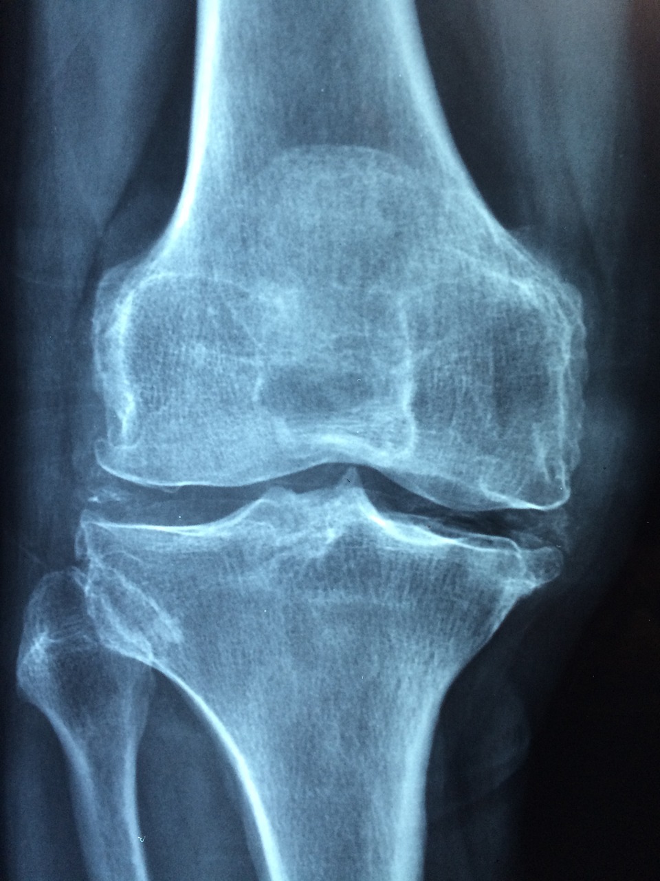 Radio de l'arthrose du genou: quel traitement naturel?