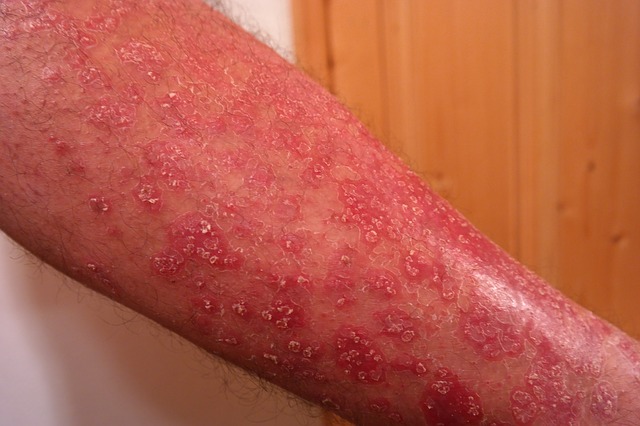 Psoriasis: les Traitements Naturels - Guide par une naturopathe ...