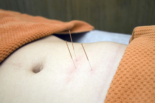 Aiguilles d'acupuncture : l'acupuncture peut être intéressante pour traiter le psoriasis.