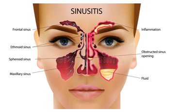 SINUSITE MAXILLAIRE PLUS: Principaux diagnostics et leur