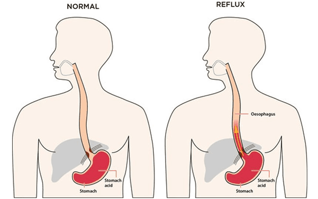 Reflux Gastro œsophagien Traitement