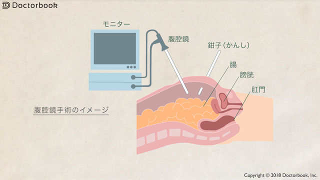 腹腔鏡手術のイメージ