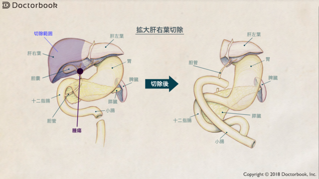 拡大肝右葉切除