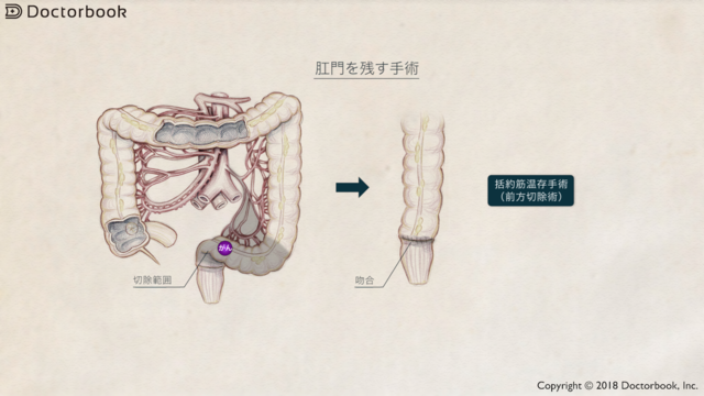 肛門を残す手術