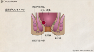 直腸がん、肛門を温存するか人工肛門にするか