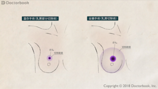 乳がんの手術、全摘か温存か