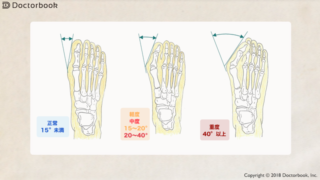 医師出演 外反母趾の治療法 痛みを緩和するための保存的治療と手術的治療 Doctorbook