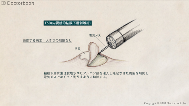 医師出演】食道がんの内視鏡治療 | Doctorbook 医師出演】食道がんの内視鏡治療 | Doctorbook