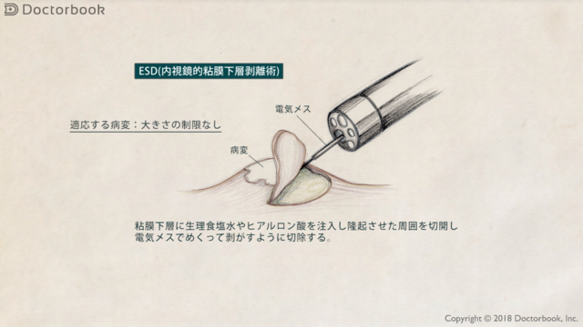 ESD（内視鏡的粘膜下層剥離術）とは