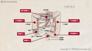 大腸がんの概要