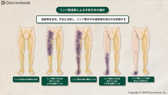 医師出演 リンパ浮腫の検査と治療 Doctorbook